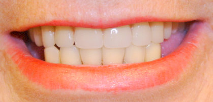 Image of old dentures