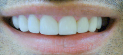 Image after veneers of a patient at Dental Comfort
