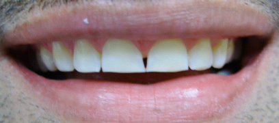 Image before veneers of a patient at Dental Comfort