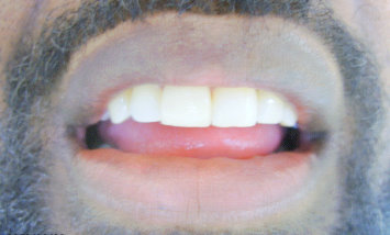 Image after veneers