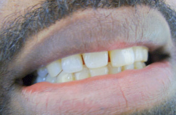 Image before veneers